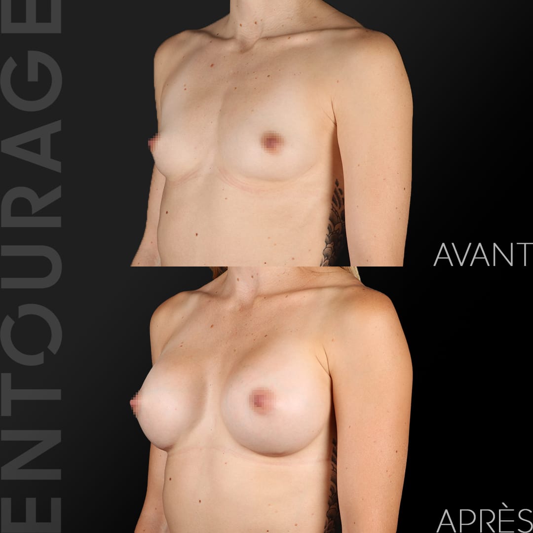 Augmentation des seins avec implants Motiva