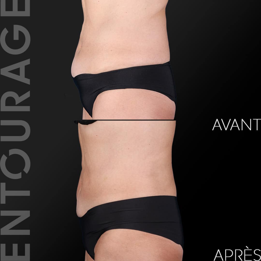 Avant-après la liposuccion Coolscupting