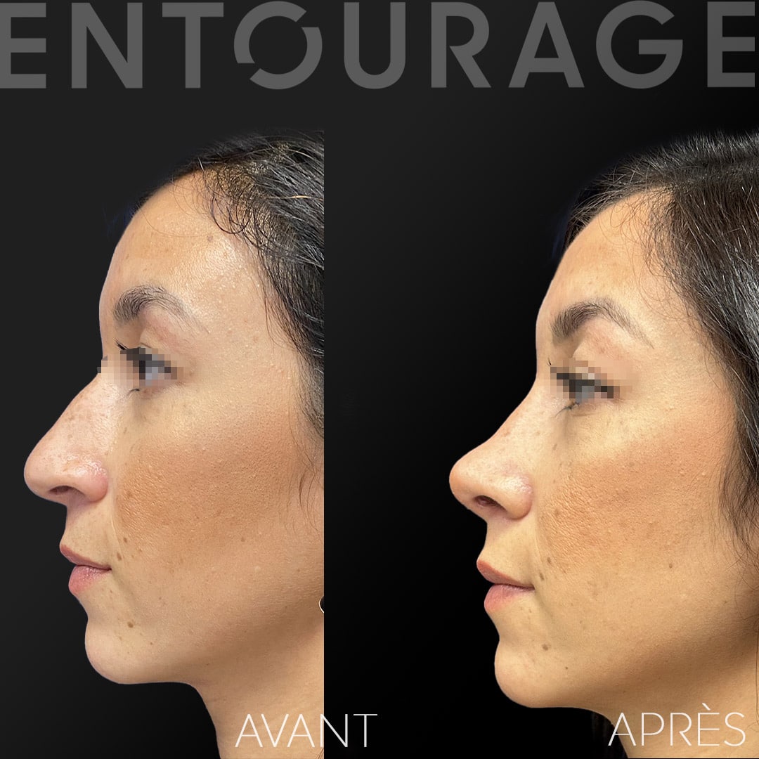 Avant-après la chirurgie du nez