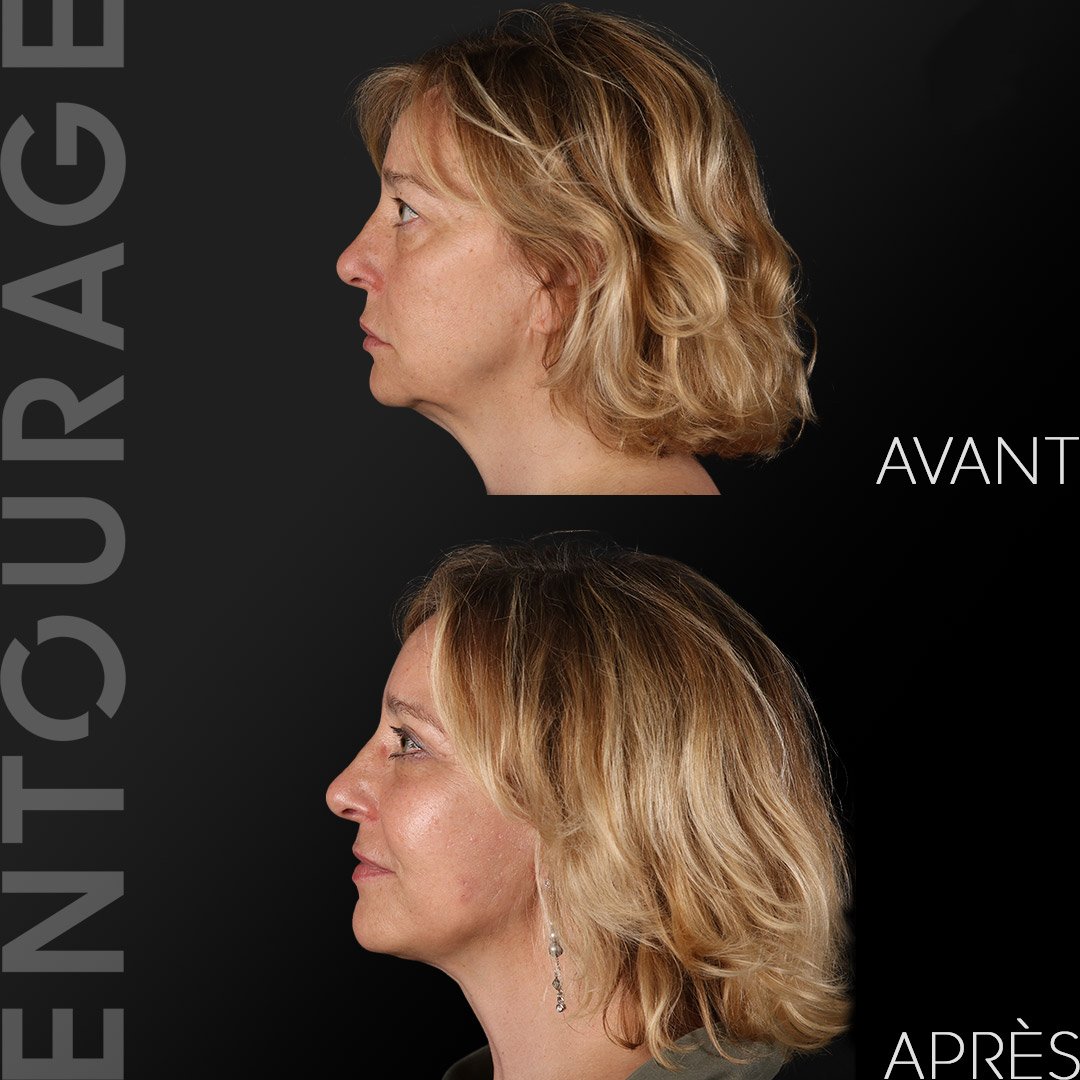 Avant après le lifting du visage