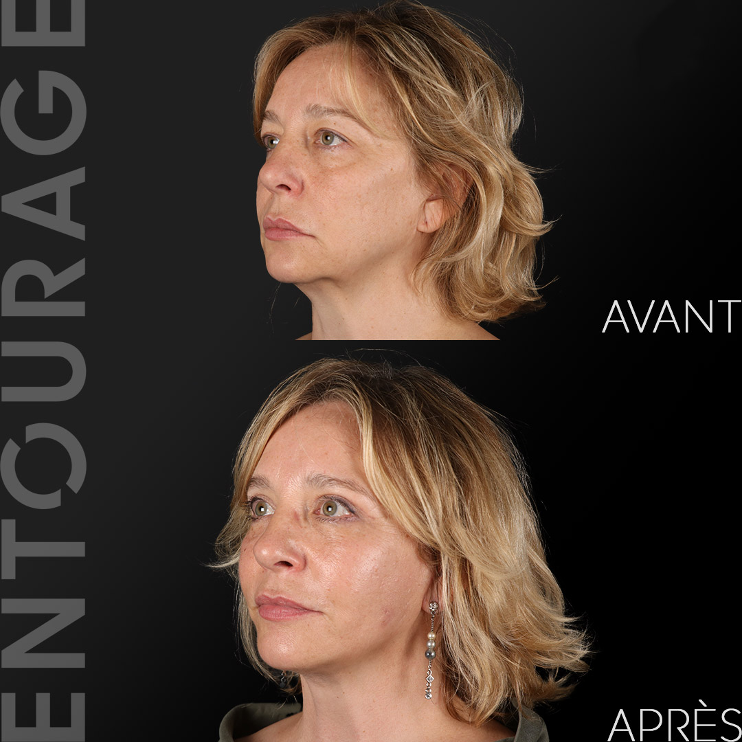 Avant après le lifting du visage