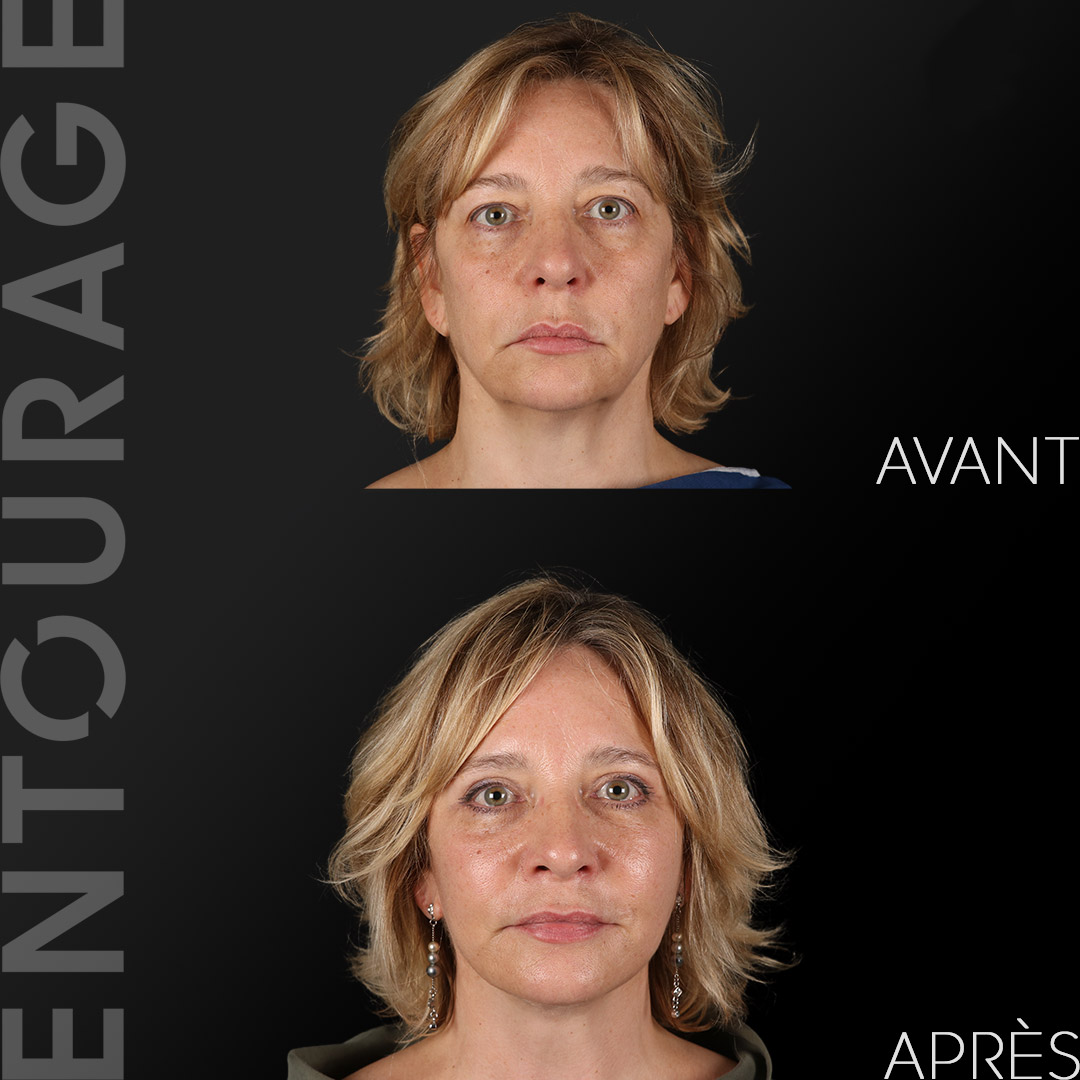 Avant après lifting pour définition du visage