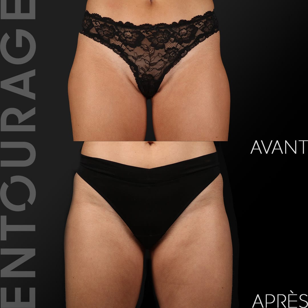 Avant après le Coolsculpting, culotte de cheval