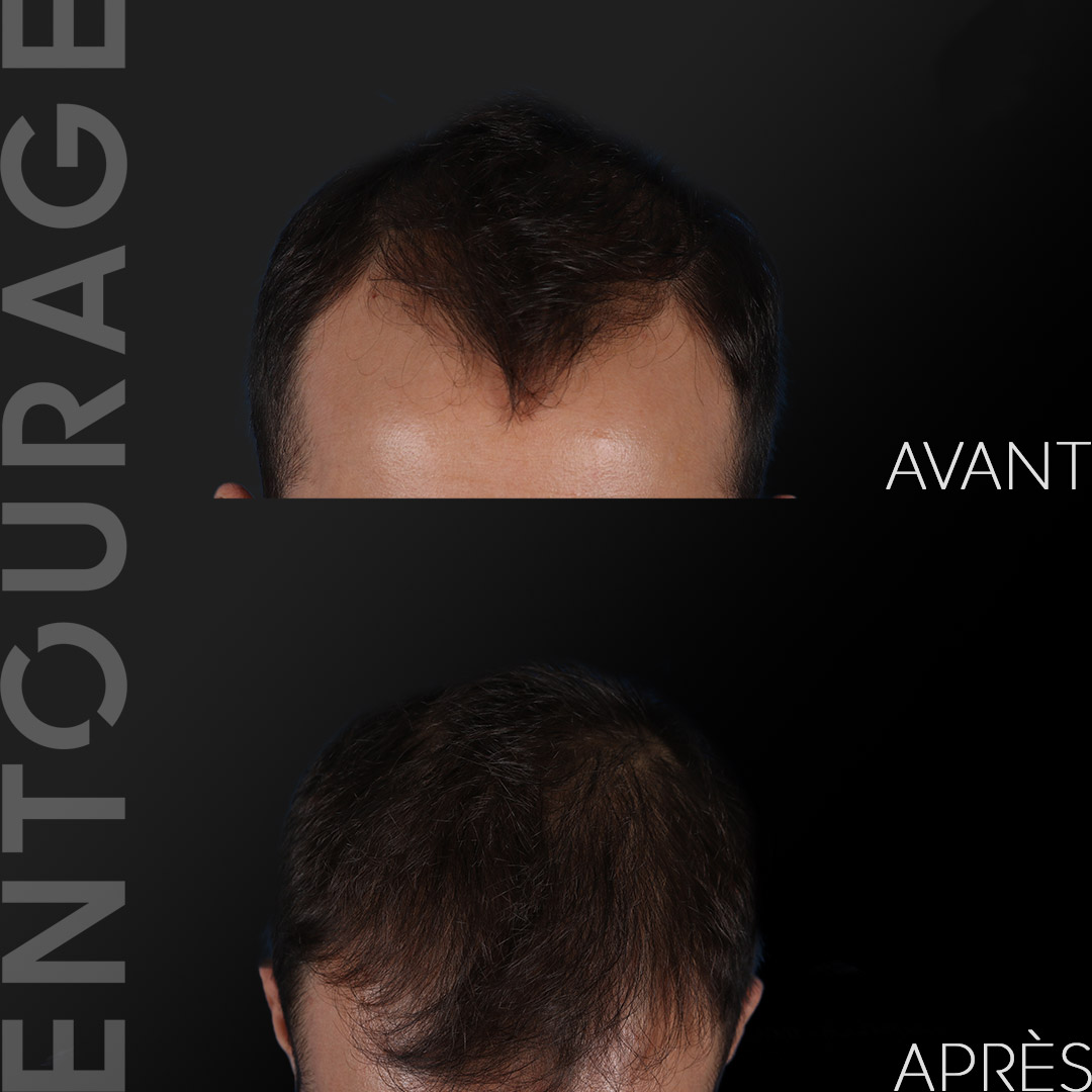 Avant après la greffe de cheveux