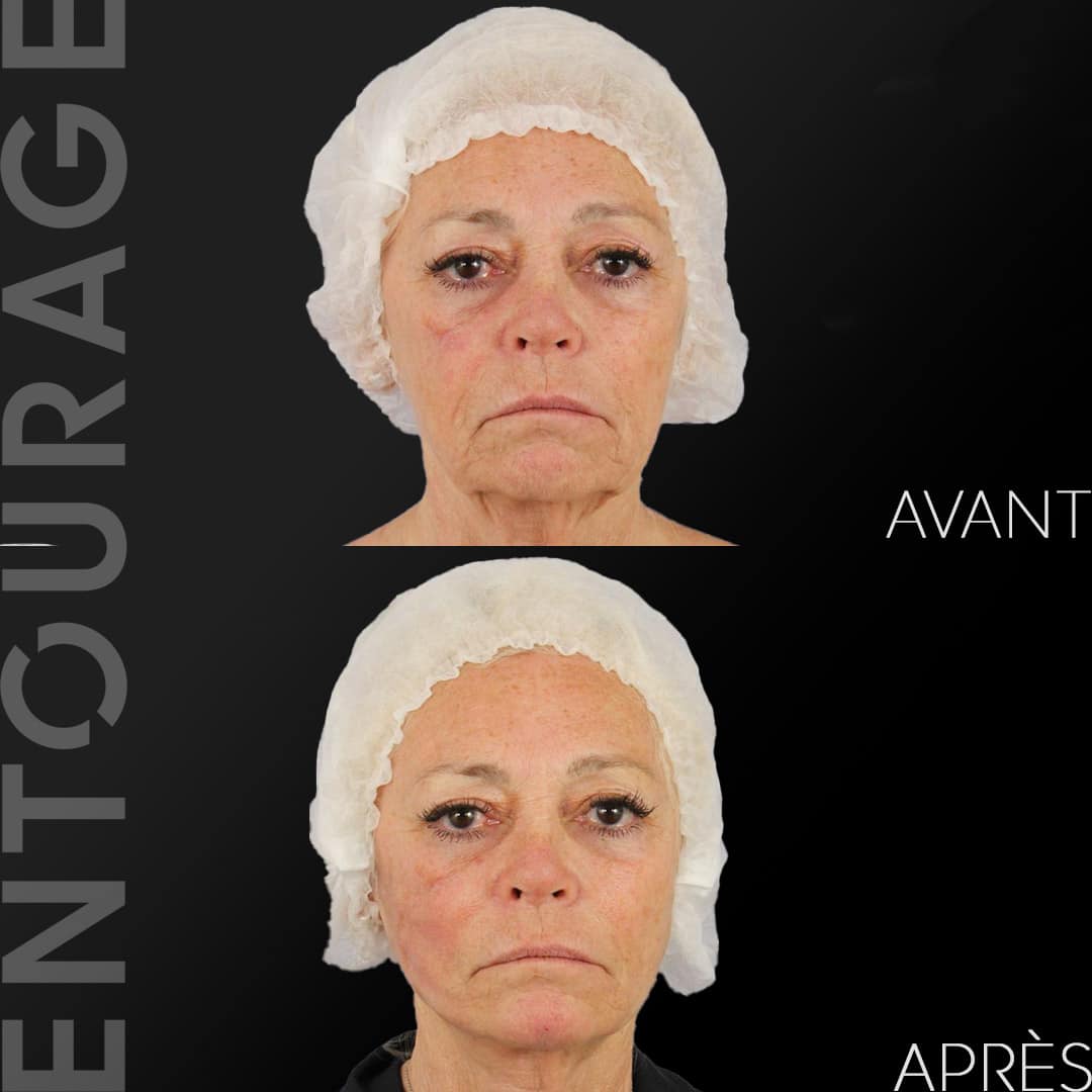 Avant-Après fils tenseurs du visage