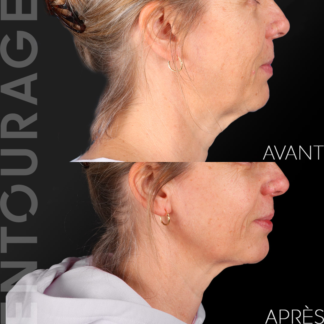 Avant-Après Ultherapy du cou