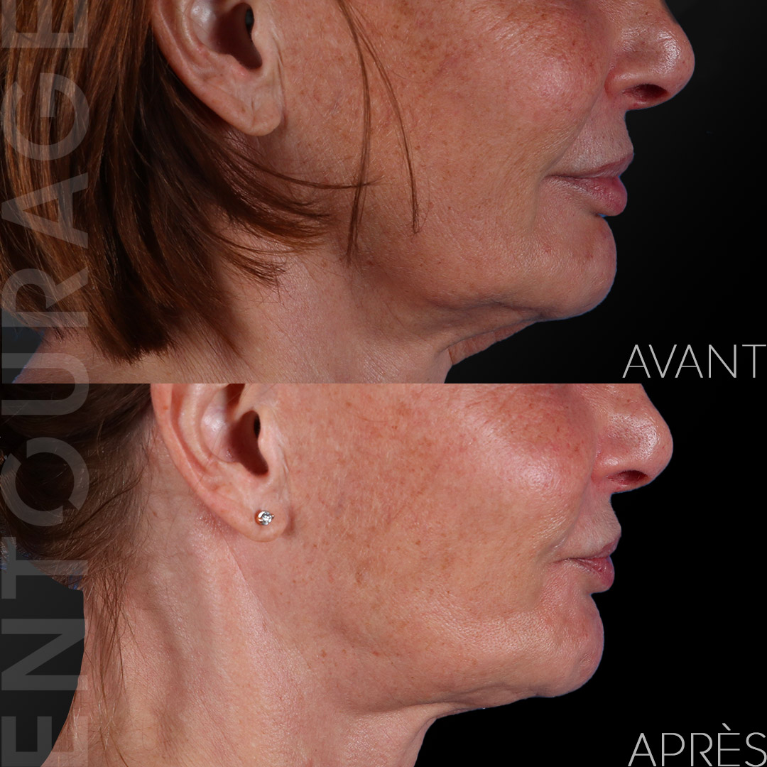 Avant-Après Ultherapy HIFU du cou