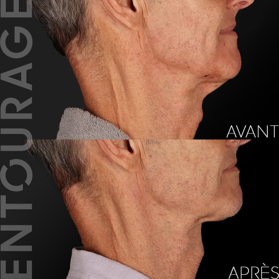 Avant/après Morpheus 8 Lausanne