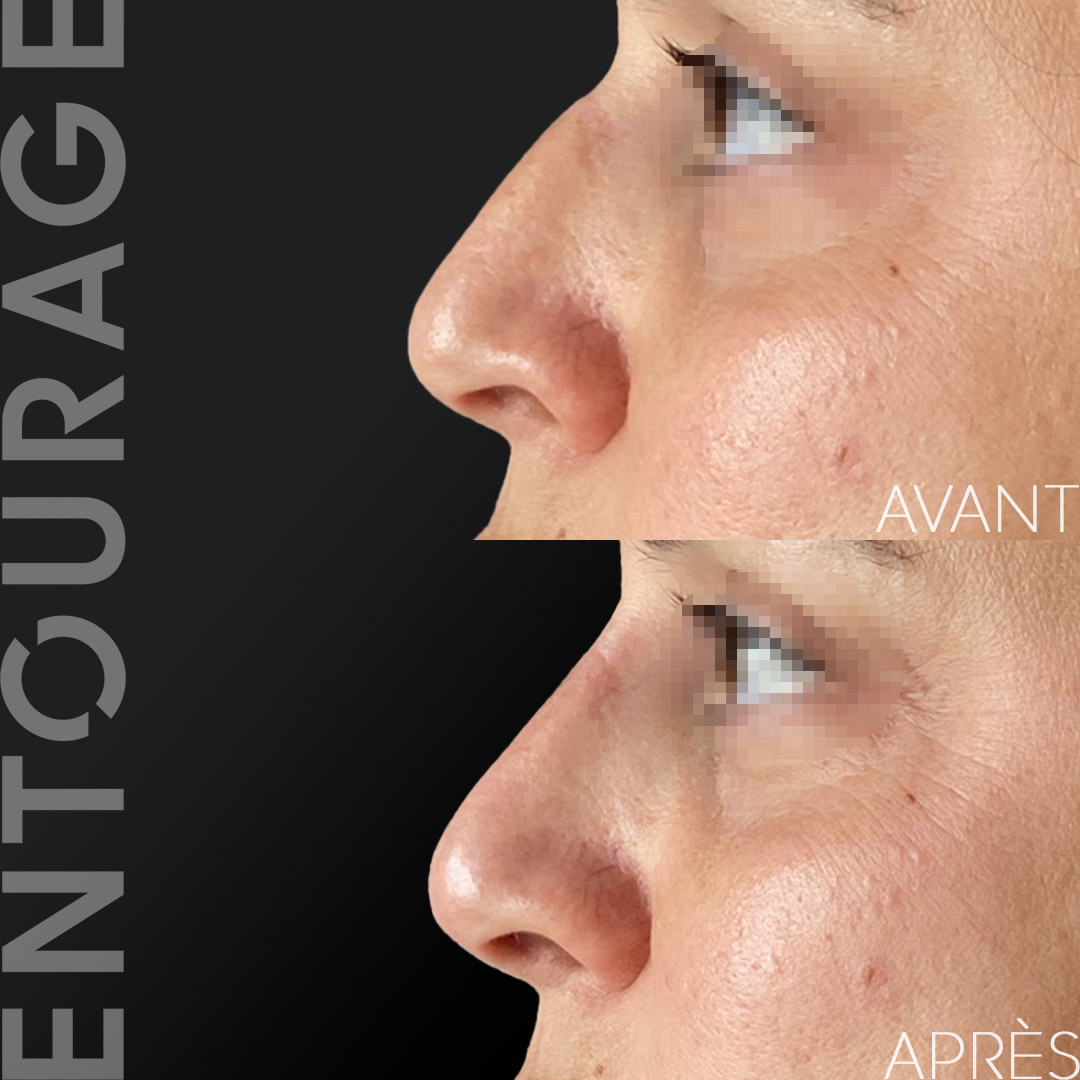 rhinoplastie médicale, injection acide hyaluronique nez