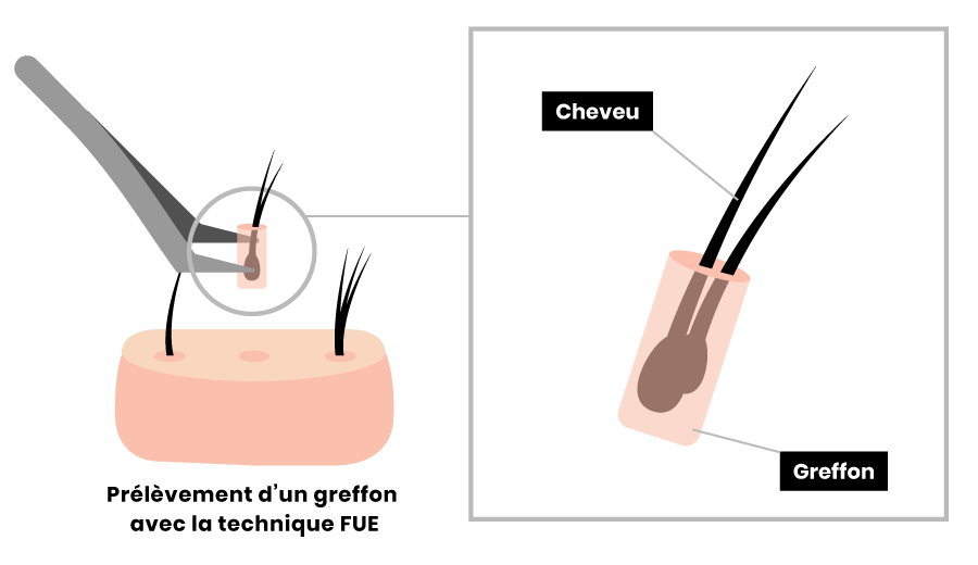 Prélèvement d'un greffon avec la technique FUE