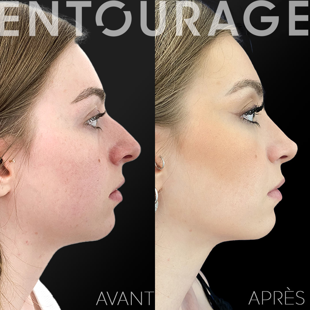 rhinoplastie à Lausanne, chirurgie du nez