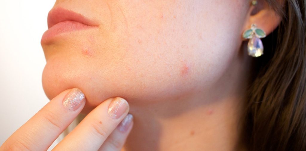 Getting rid of an acne pimple on the face