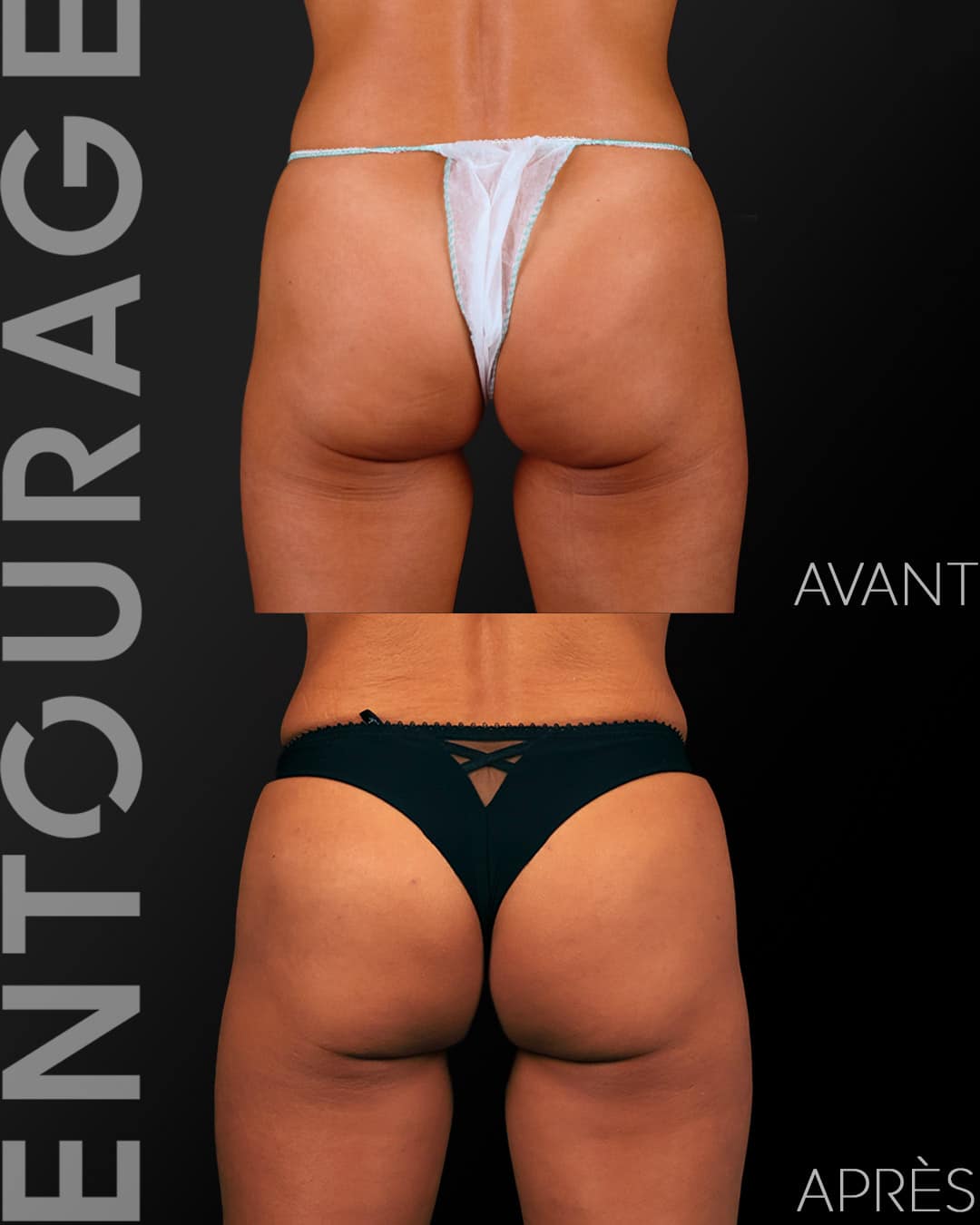 Acide hyaluronique fesses