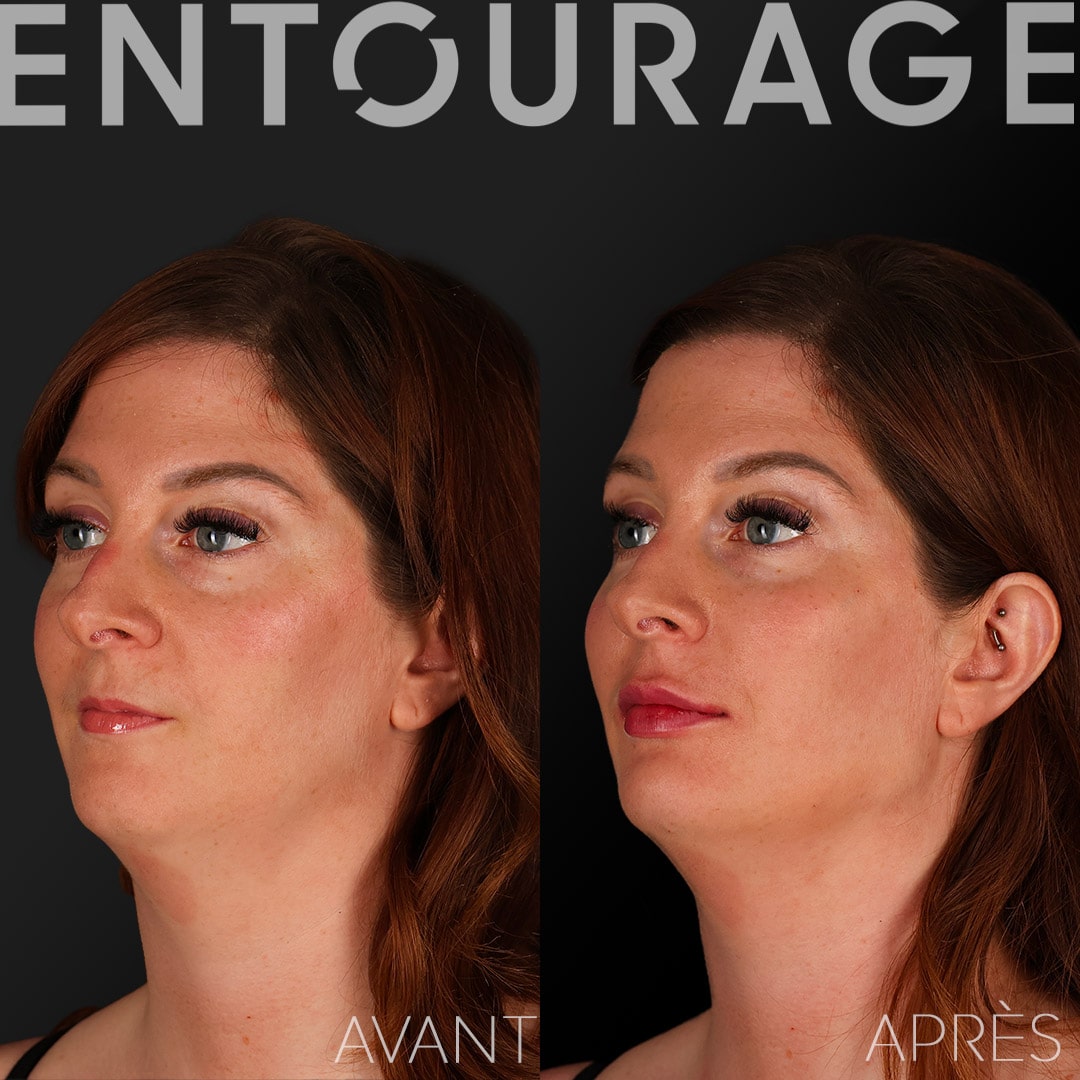 Acide hyaluronique Lausanne injeections visage
