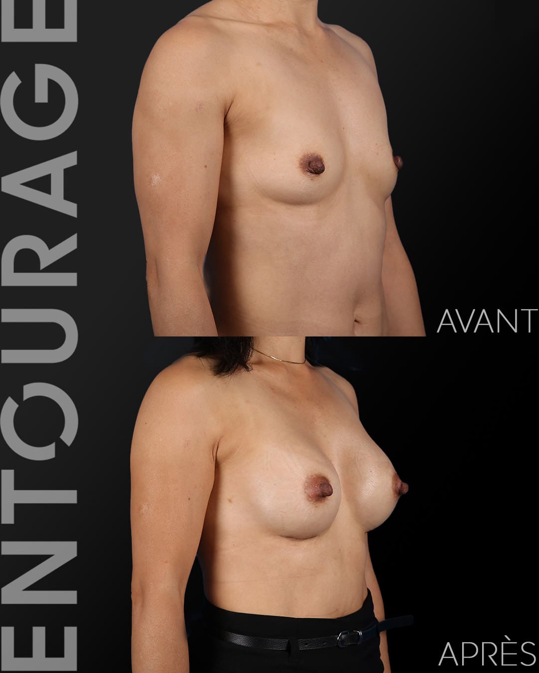 Pose d'implants mammaire avant-après