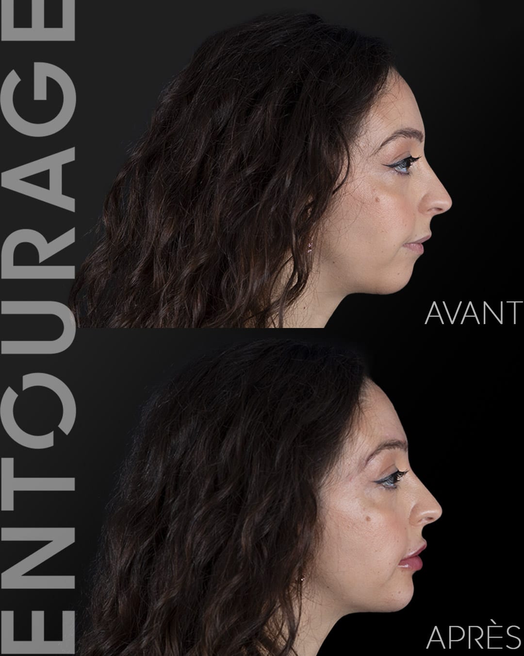 Avant après la génioplastie et lèvres