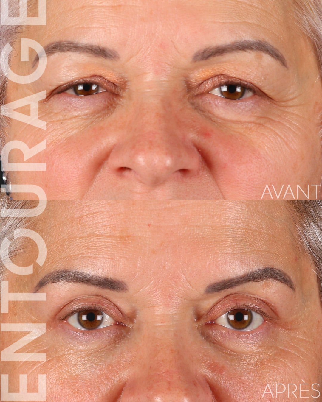 Avant après la blépharoplastie sur paupières