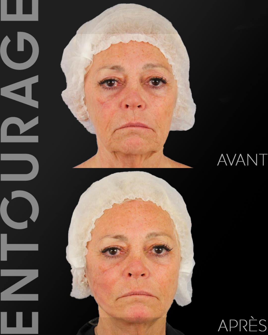 Avant-Après fils tenseurs du visage