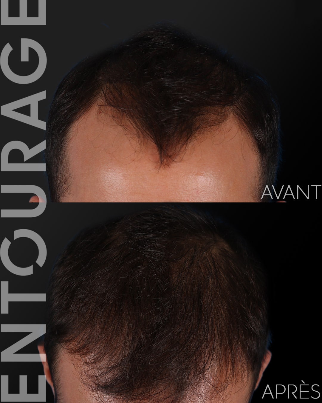 Avant/après greffe de cheveux Lausanne