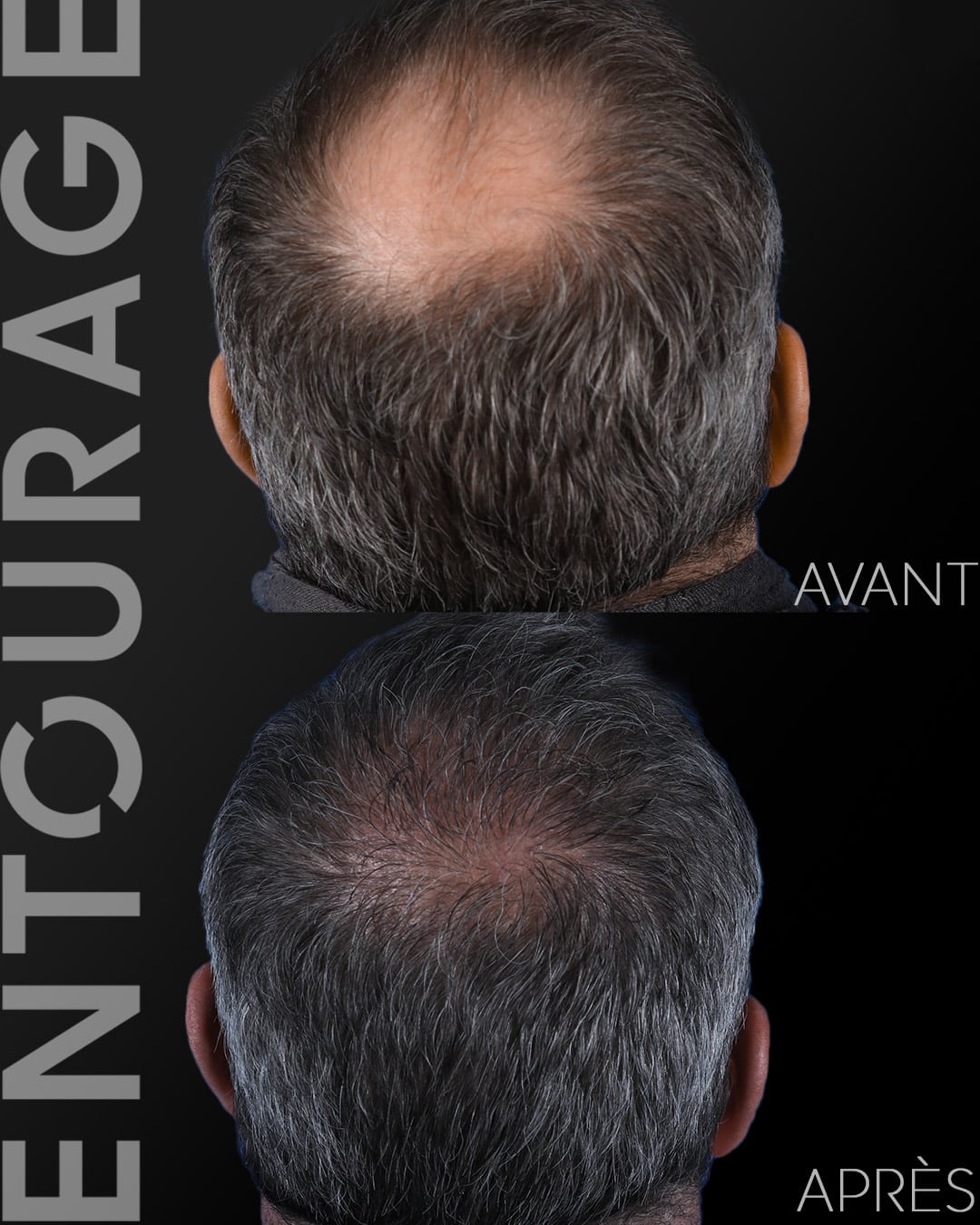 Avant/Après greffe de cheveux FUE