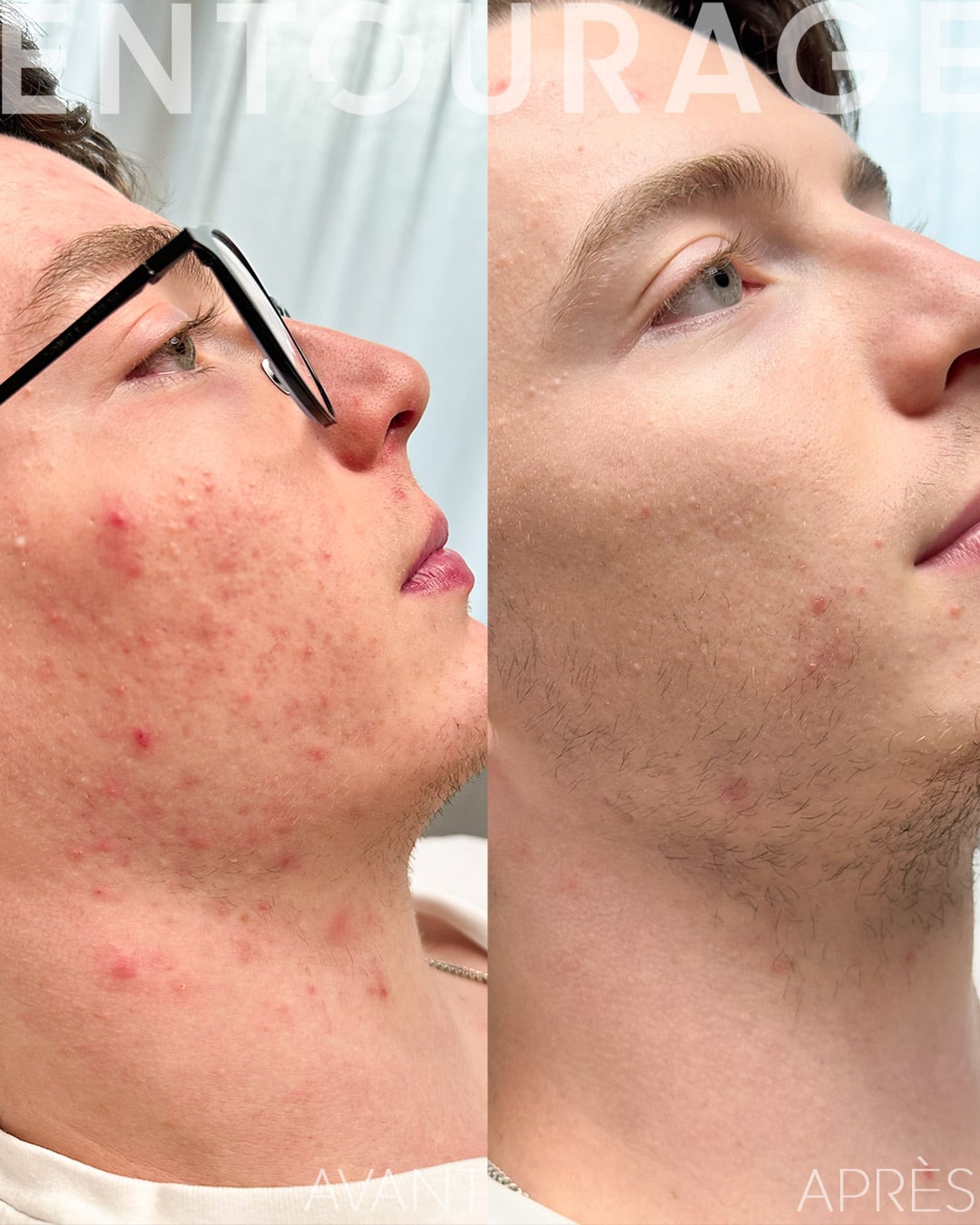 Laser acné visage