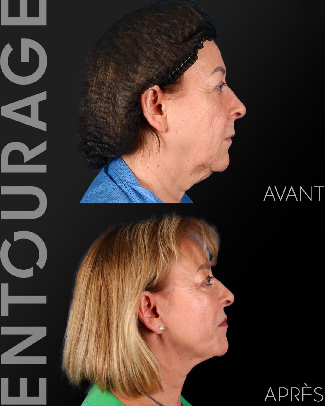 Lifting visage Avant/Après