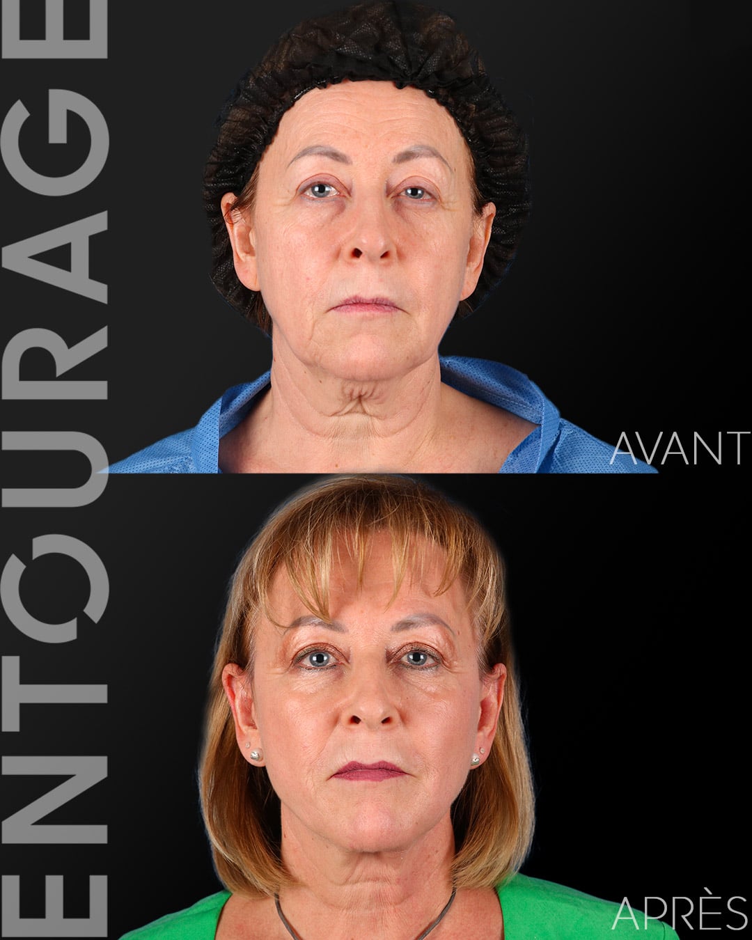 Avant/Après lifting visage deep plane lift et blépharoplastie