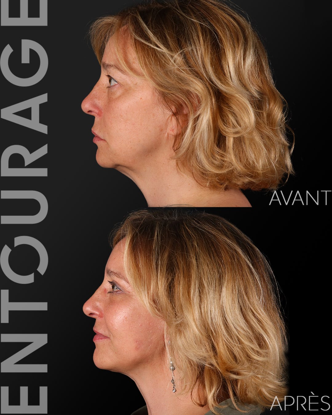 Avant après le lifting du visage