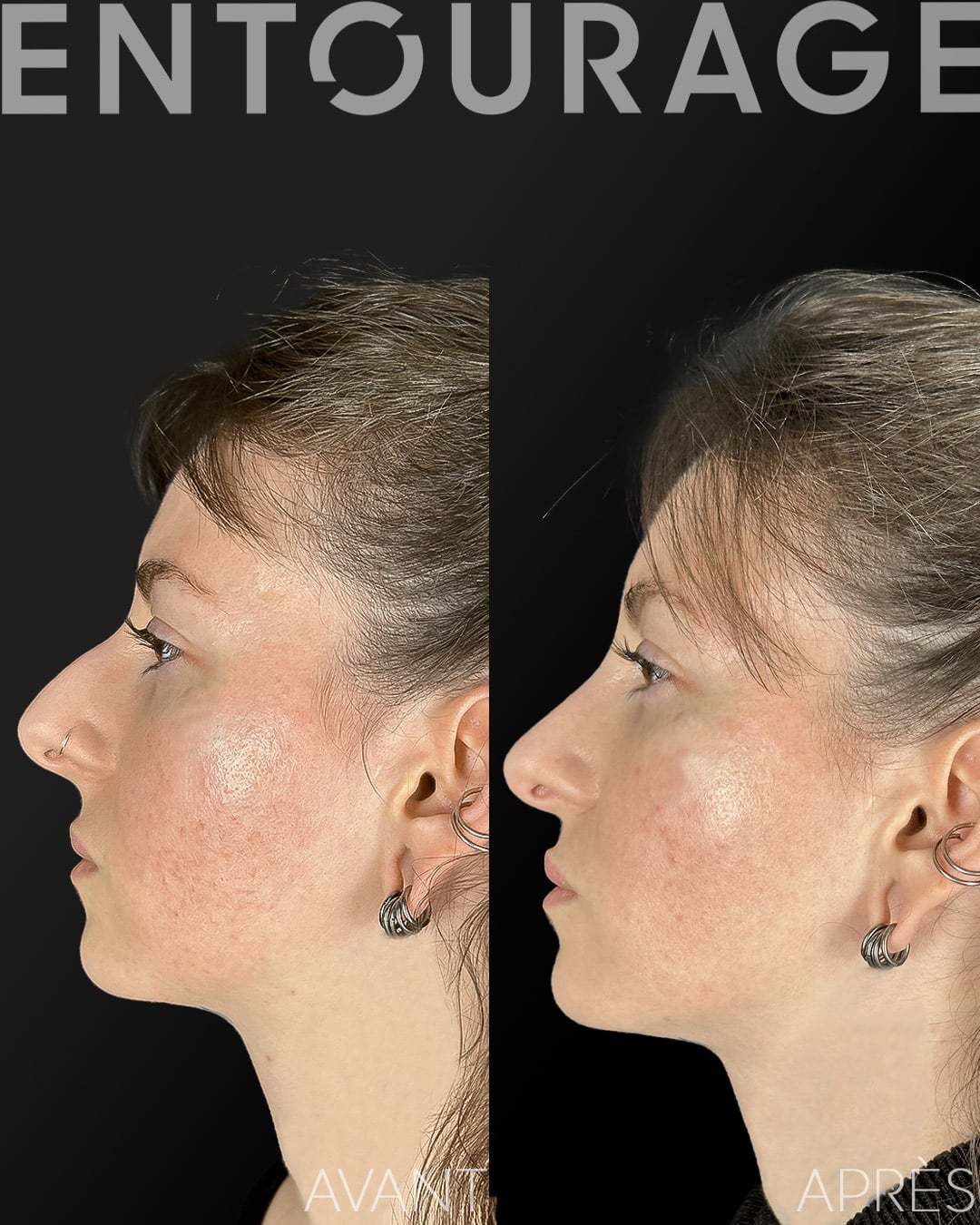 Rhinoplastie avant et après Lausanne