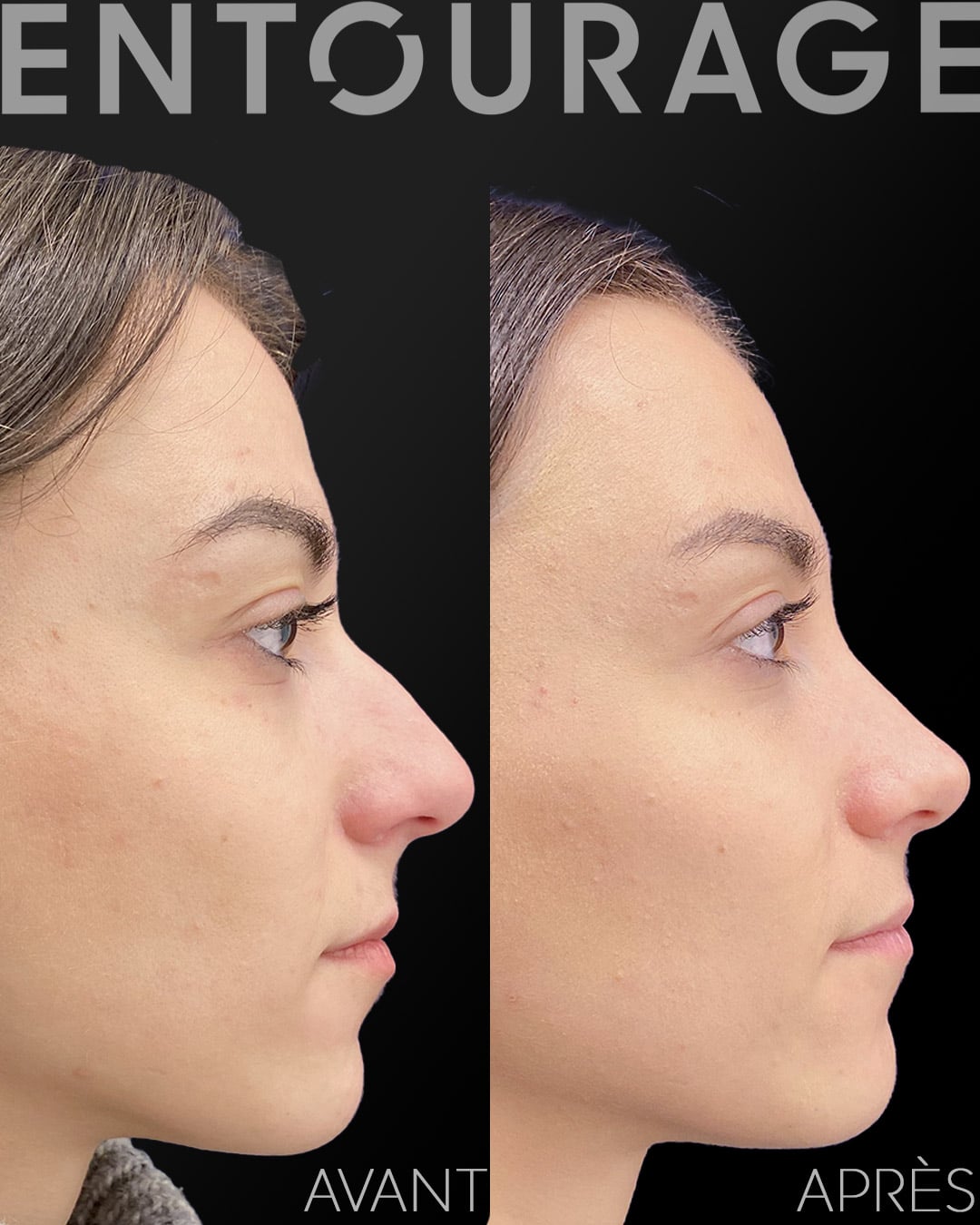 Opération du nez rhinoplastie avant après Lausanne Suisse