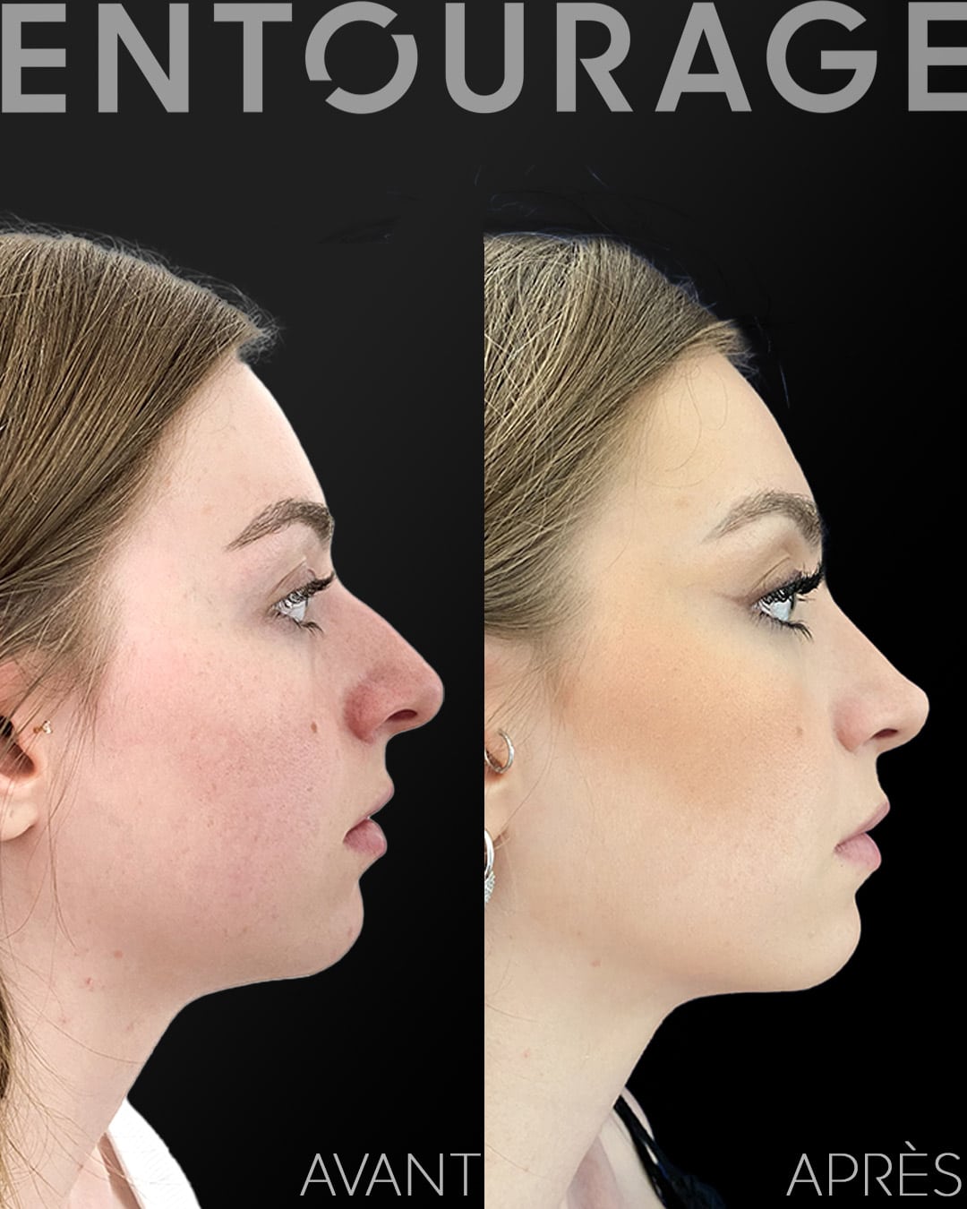 rhinoplastie à Lausanne, chirurgie du nez