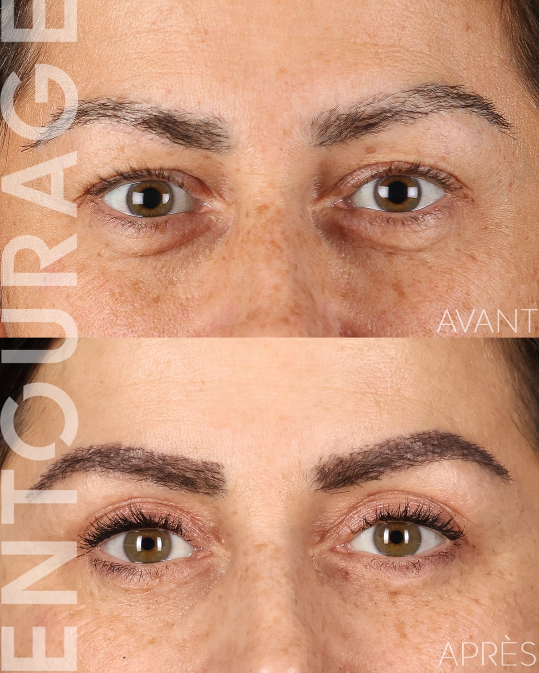 Avant-Après la blépharoplastie, poches sous les yeux