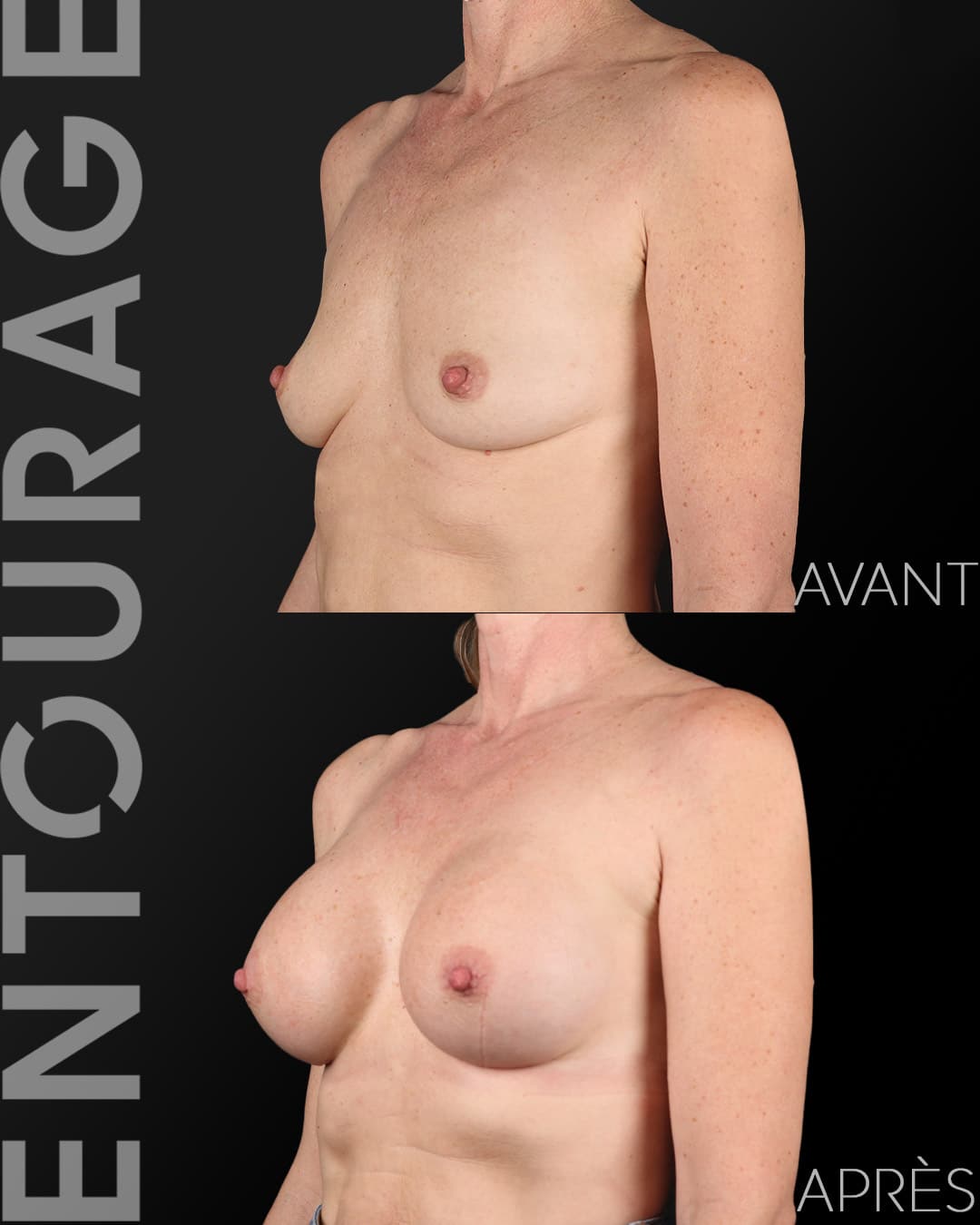 Avant Après implants Motiva Lausanne