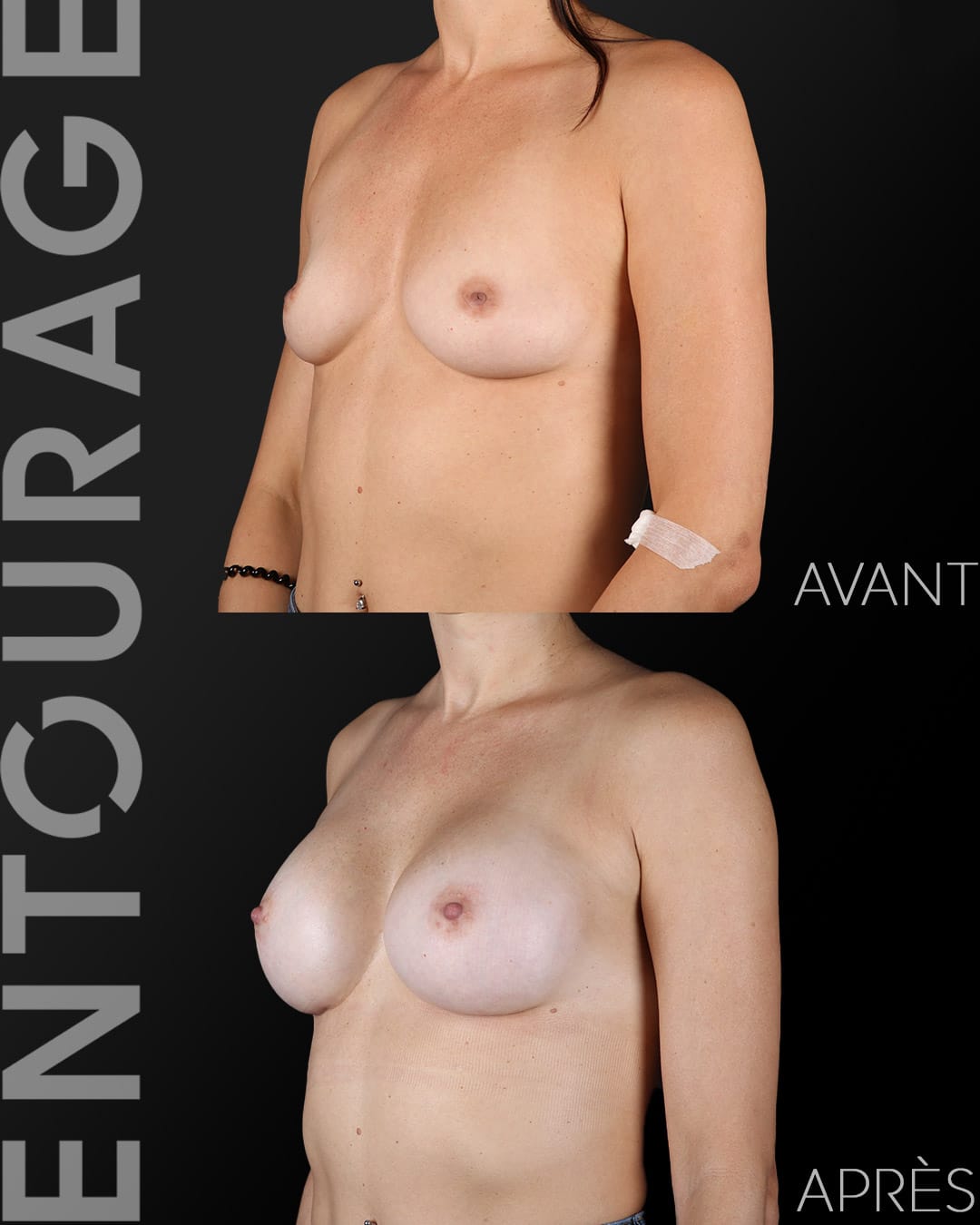 Chirurgie esthétique Lausanne augmentation mammaire avant après
