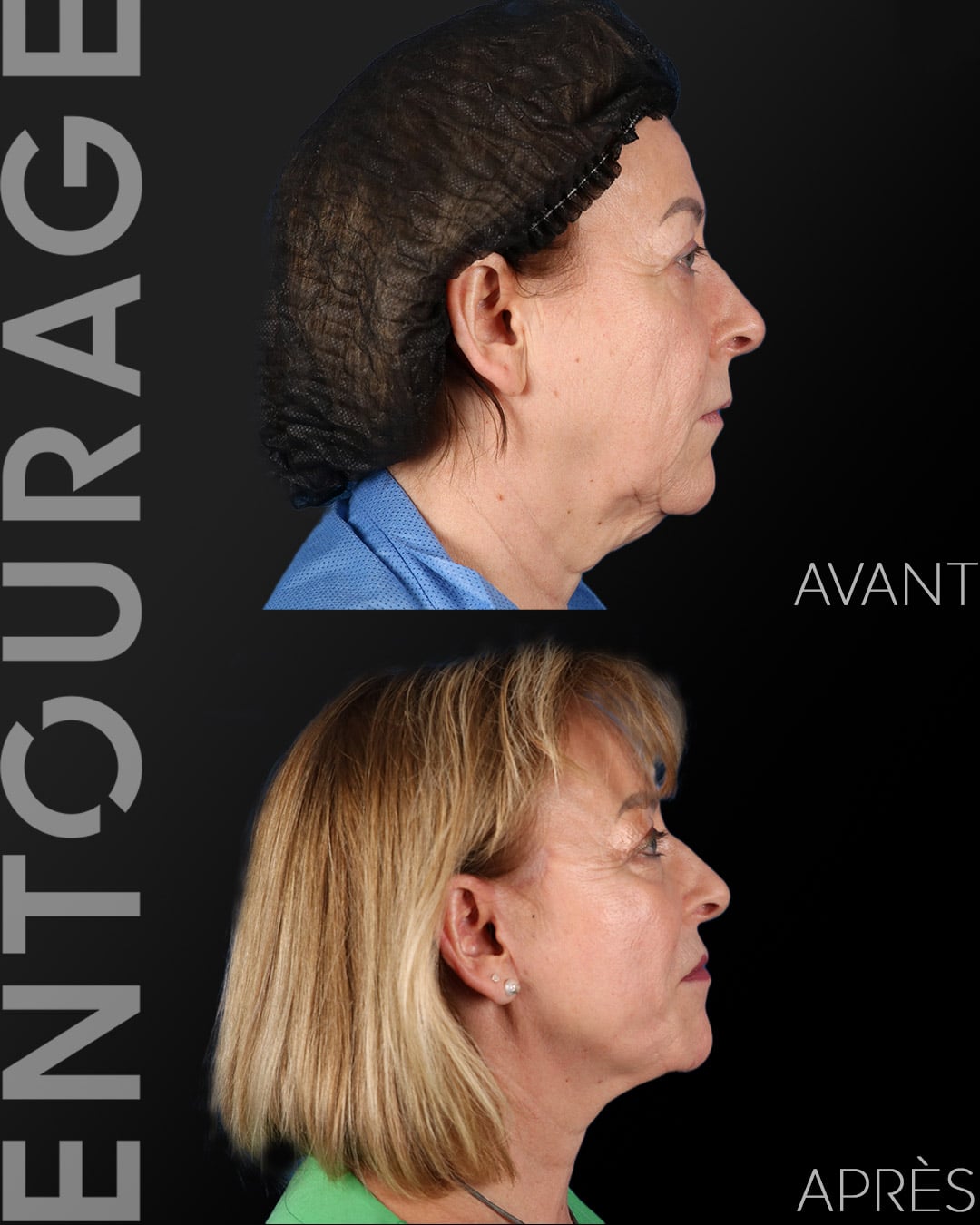 Avant après le lifting du visage