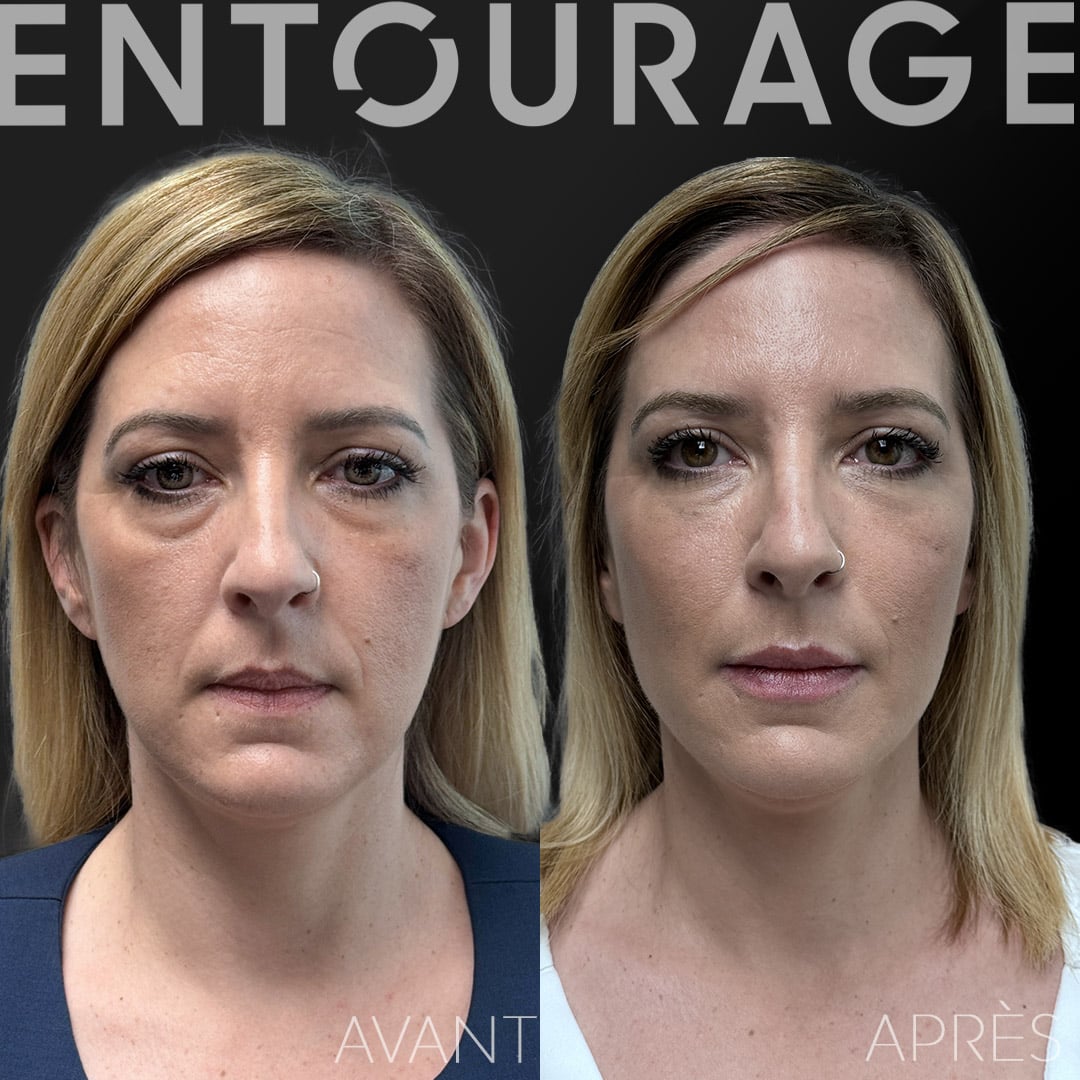 Injections visage acide hyaluronique avant après Lausanne