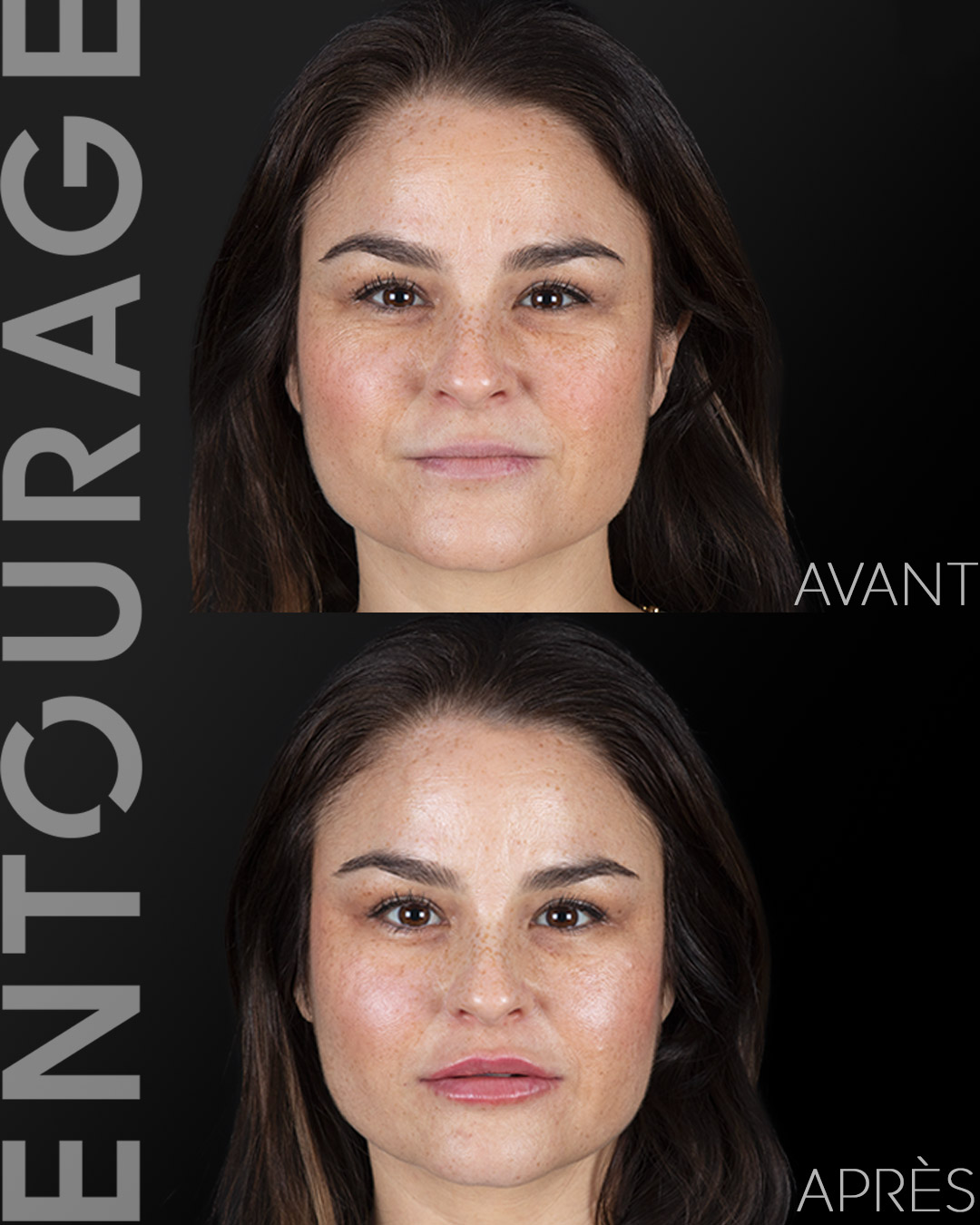 Avant après Injection visage lausanne Suisse