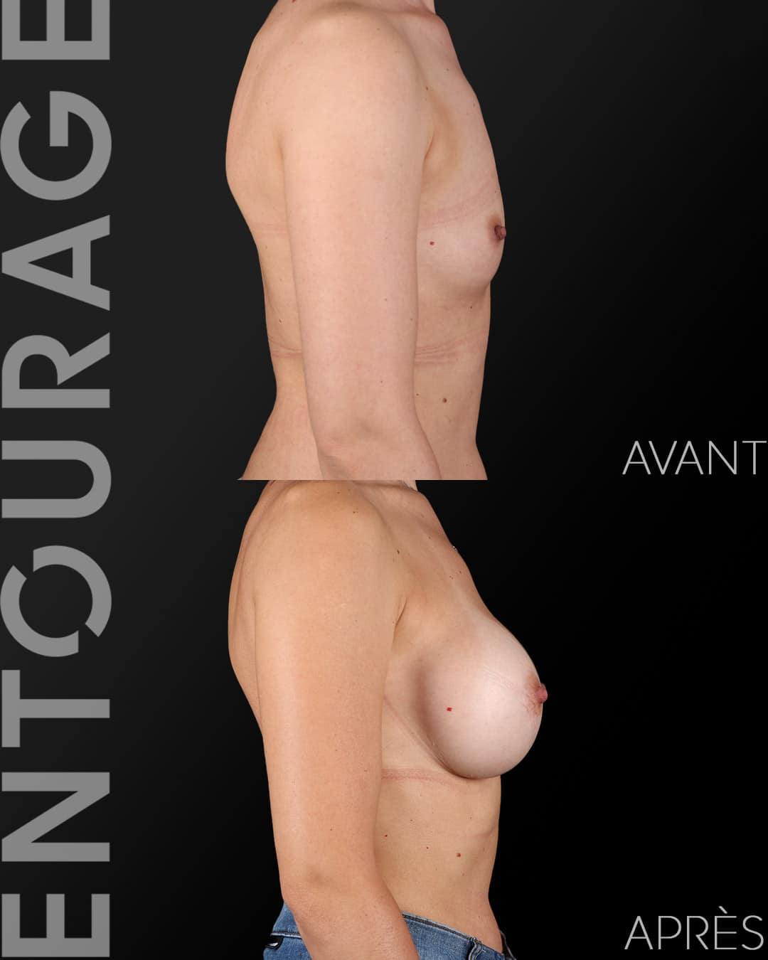 Pose d'implants mammaire avant-après