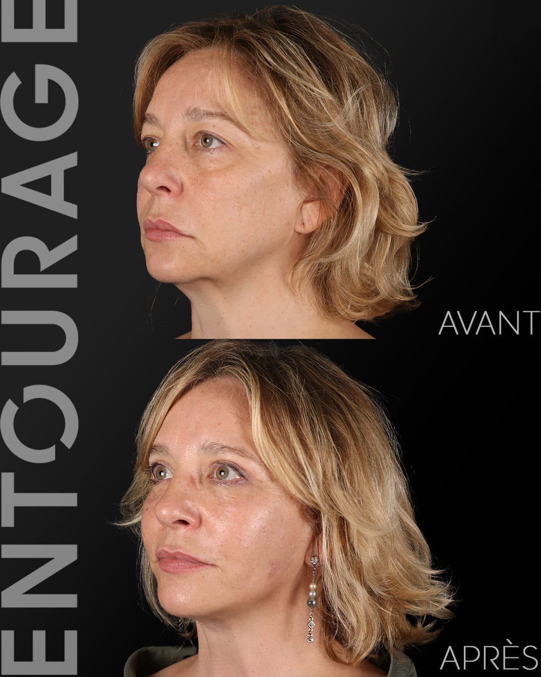 Deep plane lift avant après