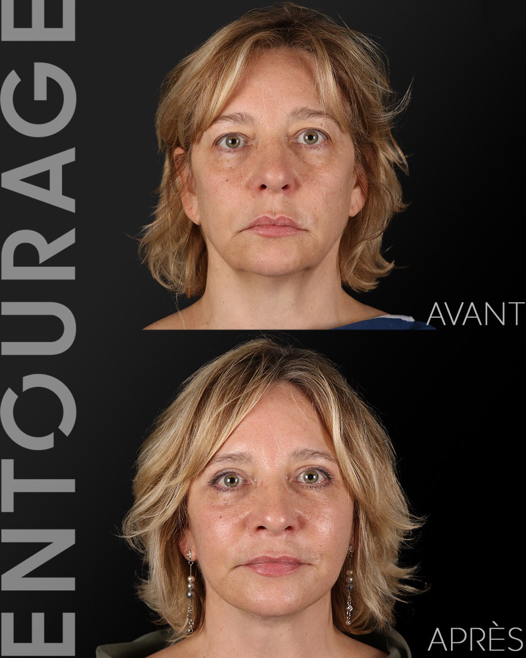 Avant après le lifting du visage