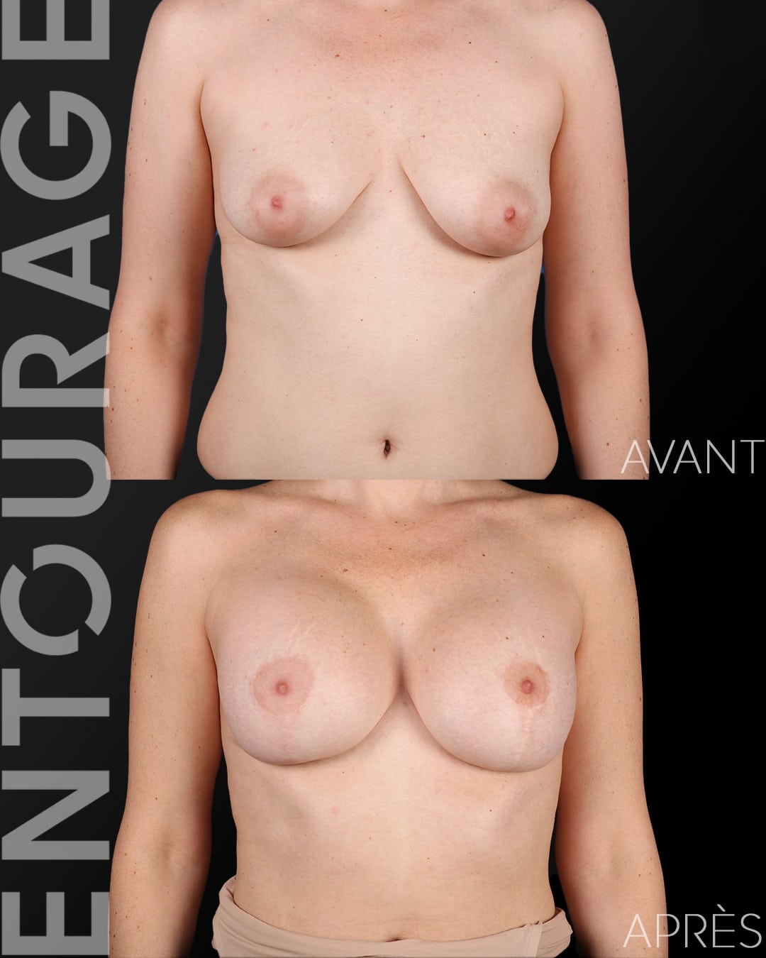 Mastopexie avec implants Lausanne avant après