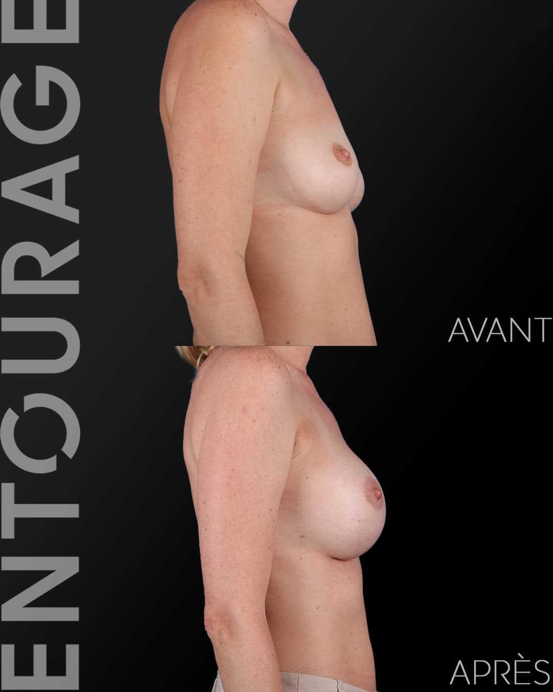 Augmentation mammaire avant après motiva