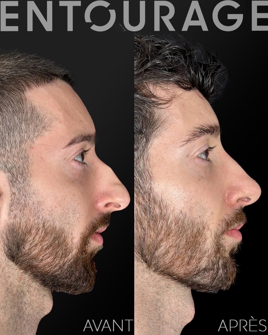 Avant après rhinoplastie