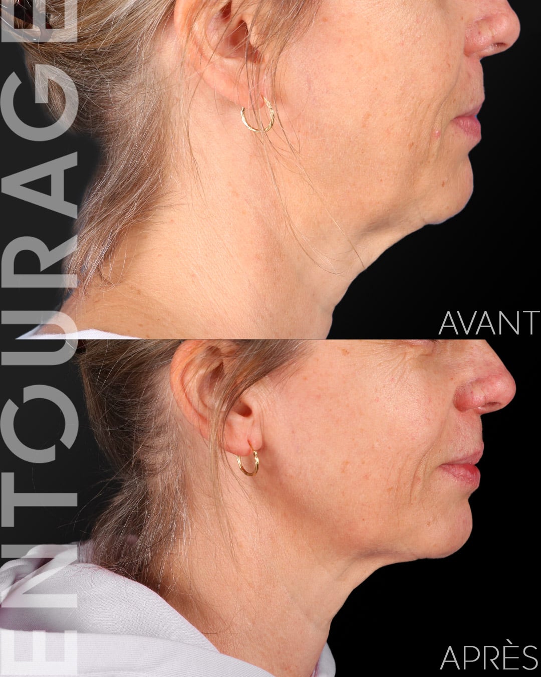Avant-Après Ultherapy du cou