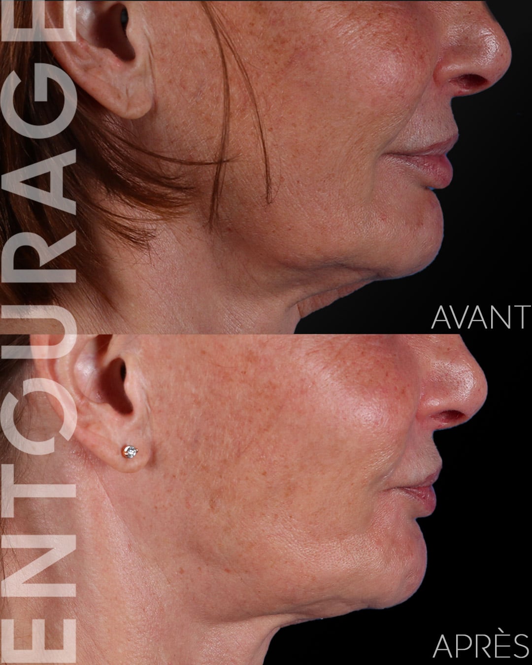Avant-Après Ultherapy Prime HIFU du cou