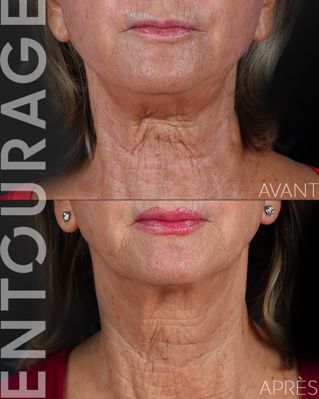 Avant-Après le lifting Ultherapy