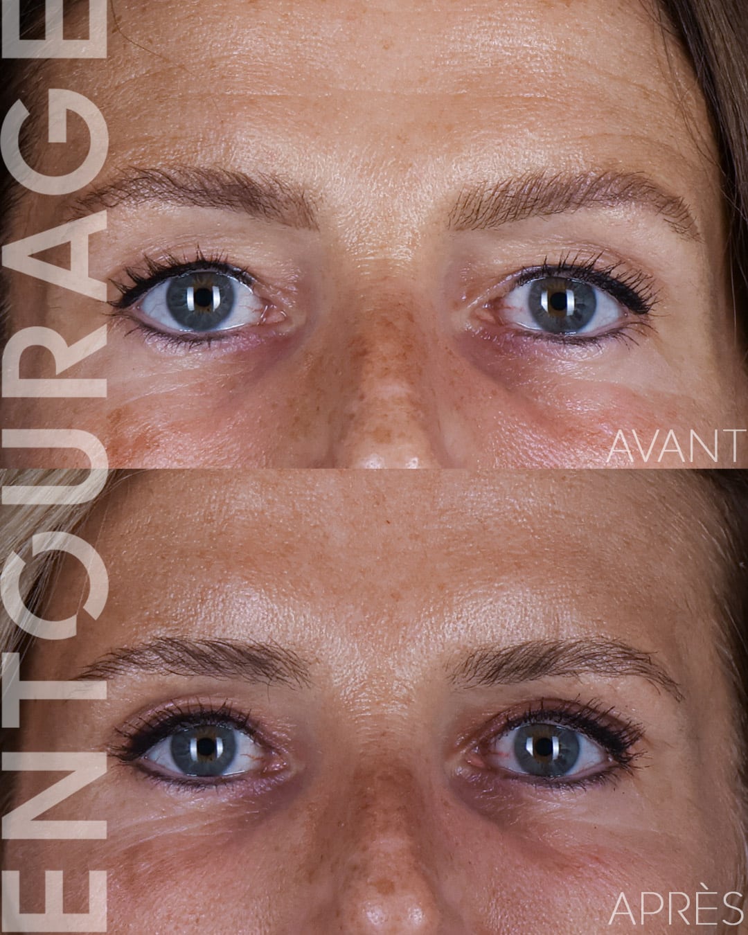 Blépharoplastie supérieure à Lausanne