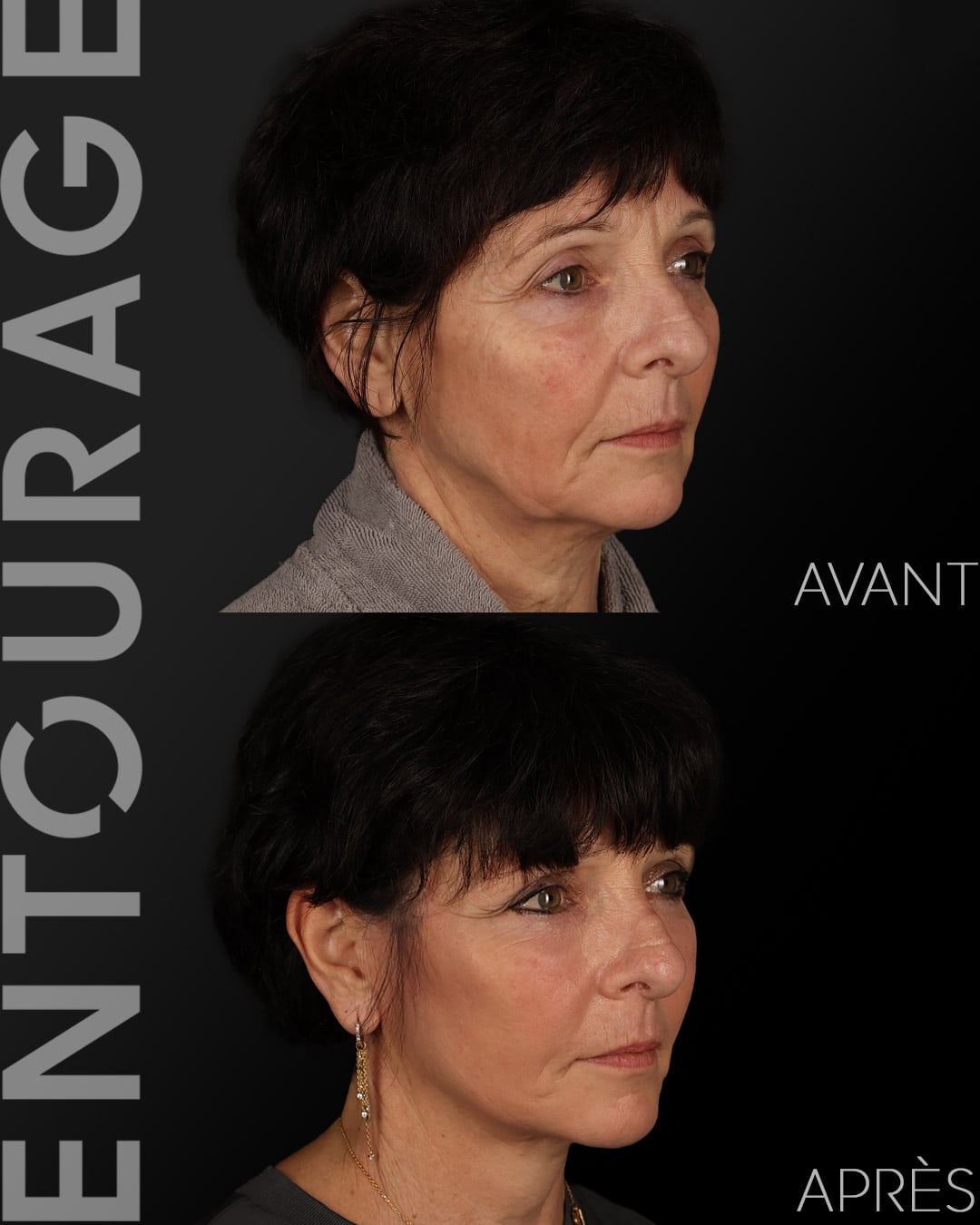 Chirurgie du visage à Lausanne lifting avant après