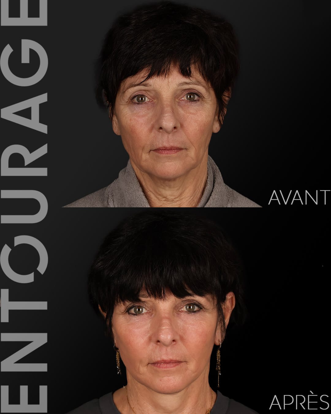 Lifting du visage à Lausanne avant après