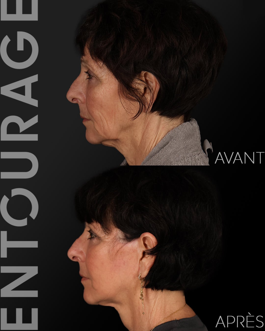 Avant après lifting Lausanne